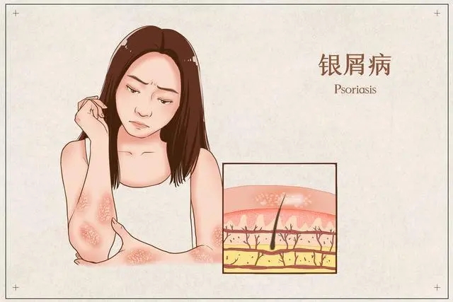 患上牛皮癣有什么危害