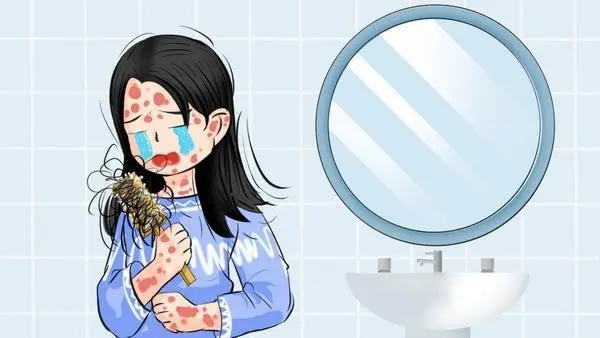女性牛皮癣患者应该注意什么