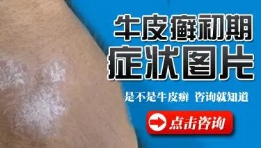 牛皮癣发病症状简介